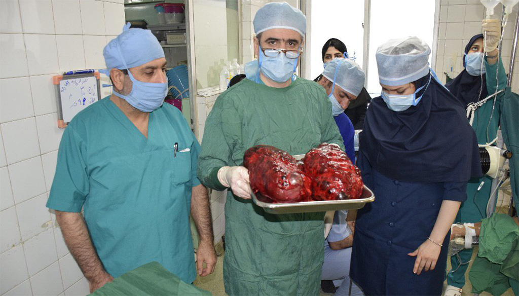 خارج کردن کلیه های پلی کیستیک با وزن 12 کیلوگرم در بیمارستان شهید بهشتی بابل